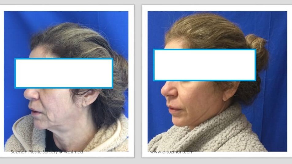 Dr. Suzman Facelift